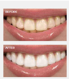 White Enhancement White Enhancement